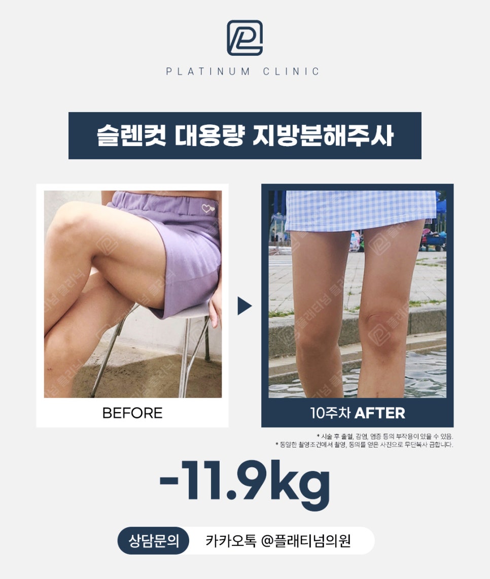 신사 지방분해주사 슬렌컷 대용량으로 11키로 감량 후기