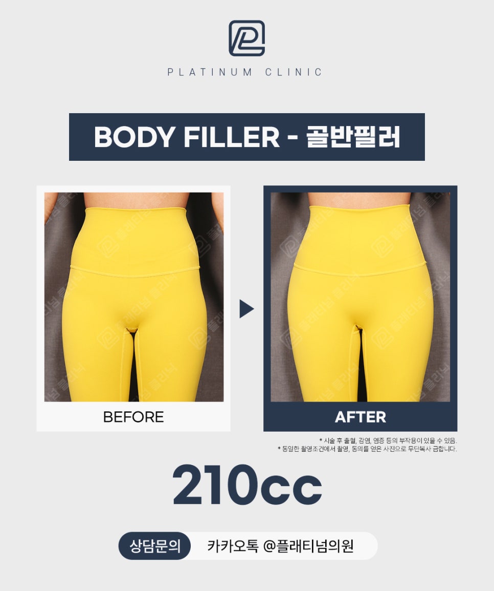 골반성형 아닌 시술로 빠르게 볼륨 살리기