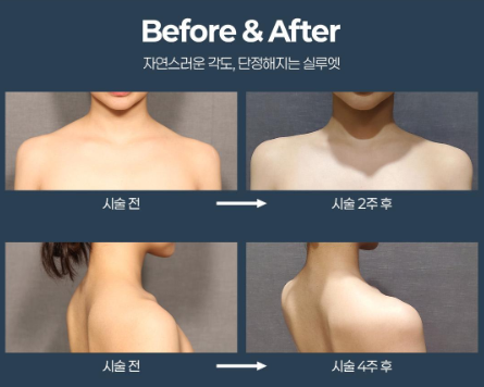 직각어깨필러 정형외과 전문의가 직접 해야 '진짜 효과' 보는 이유